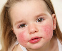 علل آلرژی کودکان شاخص
