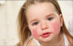 چرا دچار آلرژی میشویم؟